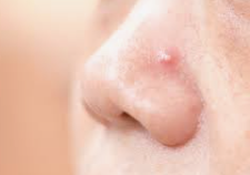 What causes acne on the nose?